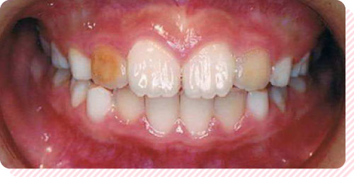 永久歯の発育に影響を及ぼす_画像